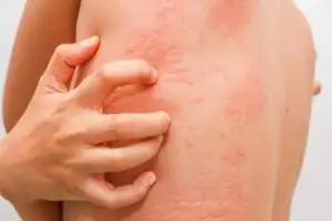 ซิฟิลิส (Syphilis) เป็นอย่างไง ?