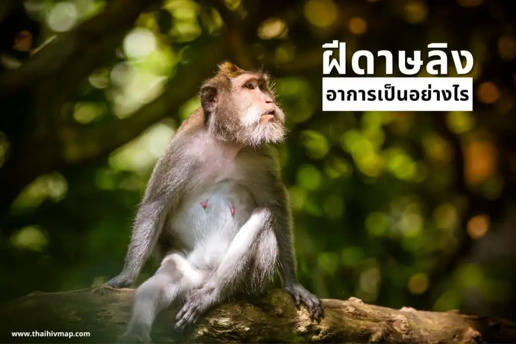 ฝีดาษลิง อาการเป็นอย่างไร ?