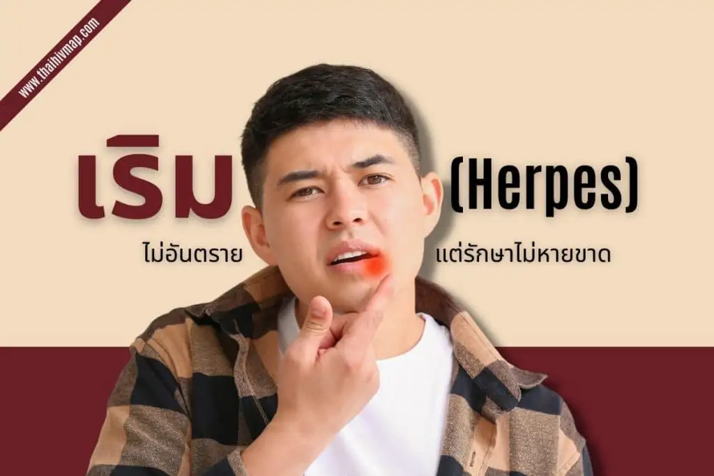 เริม (Herpes) ไม่อันตราย แต่รักษาไม่หายขาด