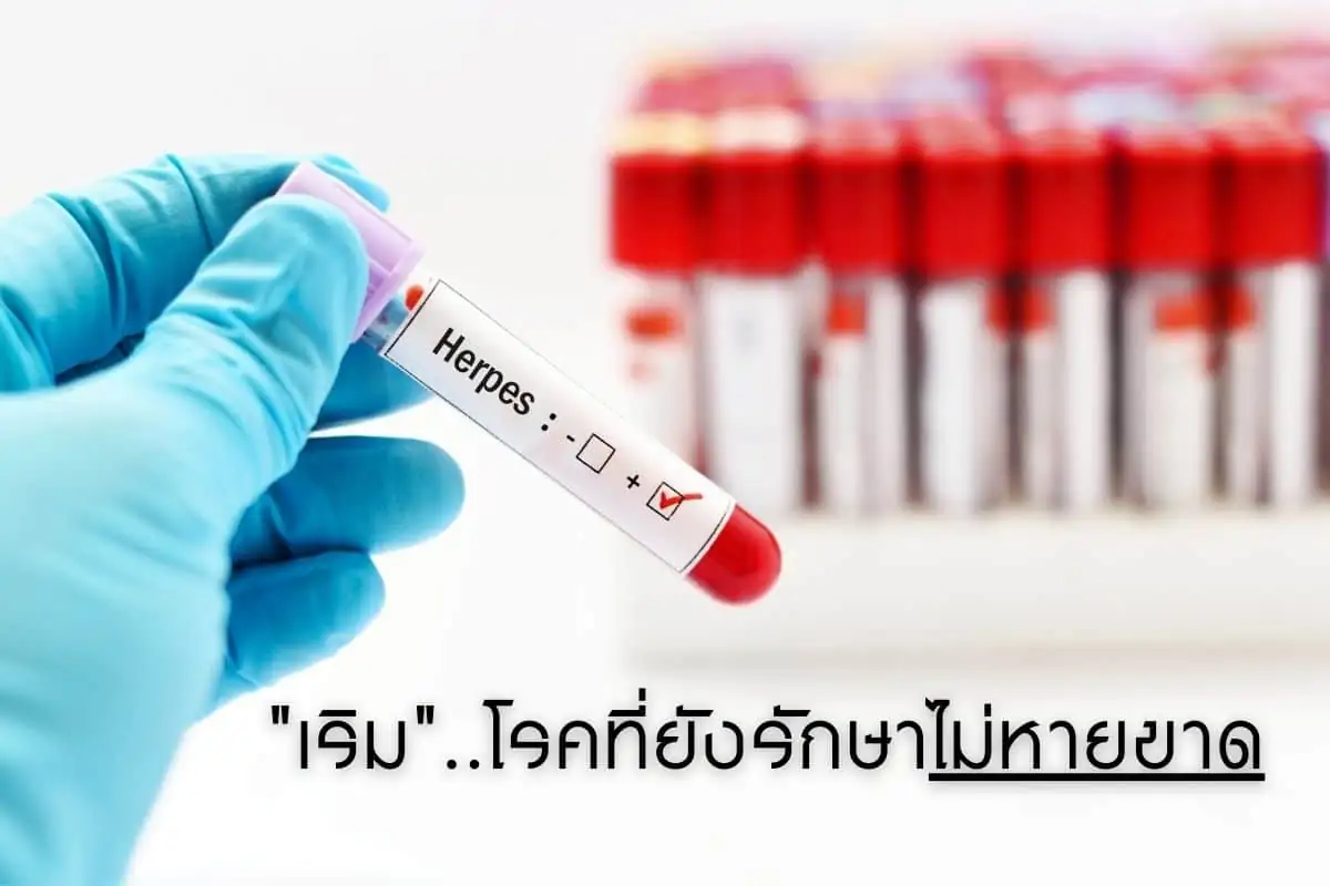 เริม..โรคที่ยังรักษาไม่หายขาด
